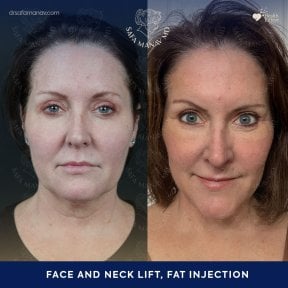 Before and after face and neck lift with fat injection results at Dr. Safa Manav Clinic