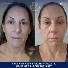 Before and after results of face and neck lift, rhinoplasty, blepharoplasty at Dr. Safa Manav Clinic