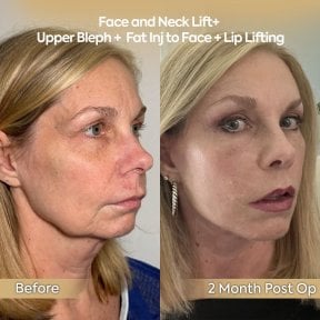Before and after facial fat transfer and facelift results at Dr. Safa Manav Clinic, 2 months post-op
