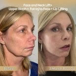 Before and after facial fat transfer and facelift results at Dr. Safa Manav Clinic, 2 months post-op