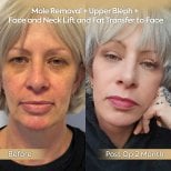 Before and after facial fat transfer, facelift, and mole removal results at Dr. Safa Manav Clinic