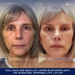 Facial fat transfer before and after results at Dr. Safa Manav Clinic, visible rejuvenation