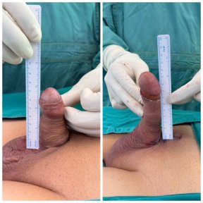 before-after photo penile-implant-surgery