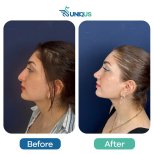 نتائج تجميل الأنف قبل وبعد في Uniqus Health، تحسين شكل الأنف والملف الجانبي