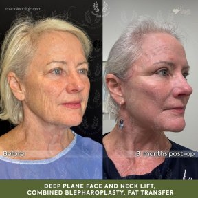 before-after photo deep-plane-facelift