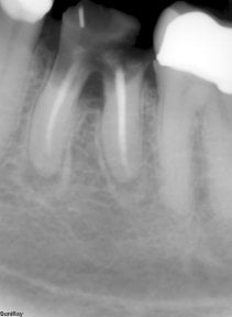 before-after photo dental-implant