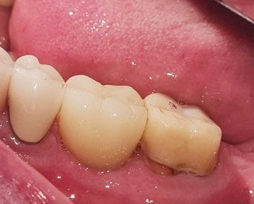 before-after photo dental-implant