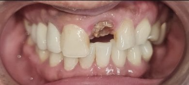 before-after photo dental-implant