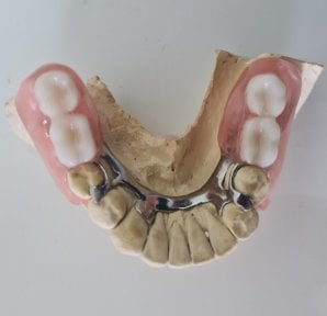 before-after photo denture