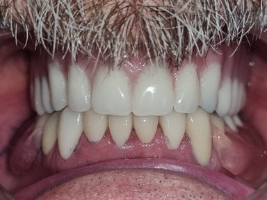 before-after photo denture