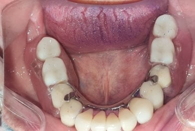 before-after photo denture