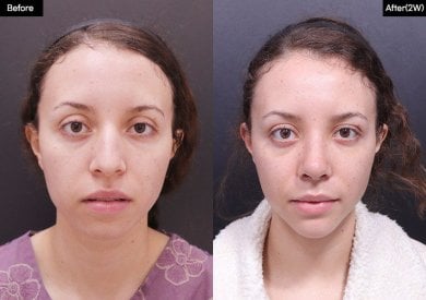 Before and after cheek implants at VG Plastic Surgery, enhanced cheek volume and contour result