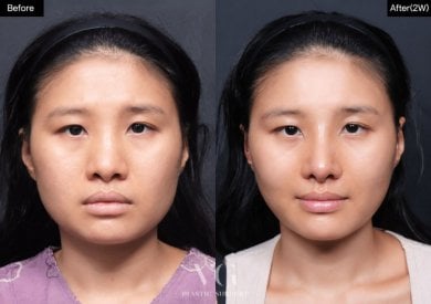 Before and after cheek implants at VG Plastic Surgery, enhanced cheek volume and facial contour result
