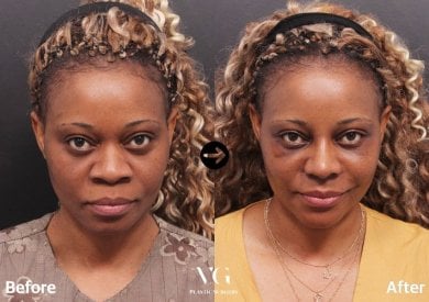 Before and after cheek implants at VG Plastic Surgery, enhanced cheek volume and contour result