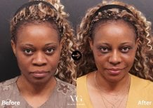 Before and after cheek implants at VG Plastic Surgery, enhanced cheek volume and contour result