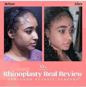 Before and after rhinoplasty results at VG Plastic Surgery, nose reshaping with natural look