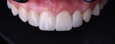 Dental implant result at Dentaland Premium Luxury Clinic & Academy – natural smile restoration