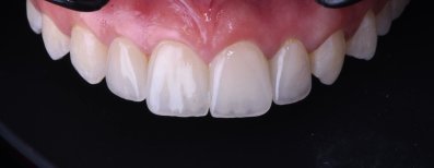 Dental implant result at Dentaland Premium Luxury Clinic & Academy – natural smile restoration