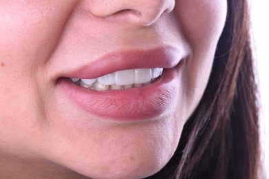 Dental implant result at Dentaland Premium Luxury Clinic & Academy, natural smile restoration