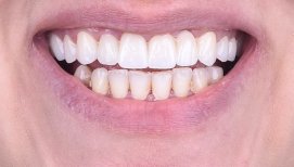 Dental implant result at Dentaland Premium Luxury Clinic & Academy – restored upper teeth