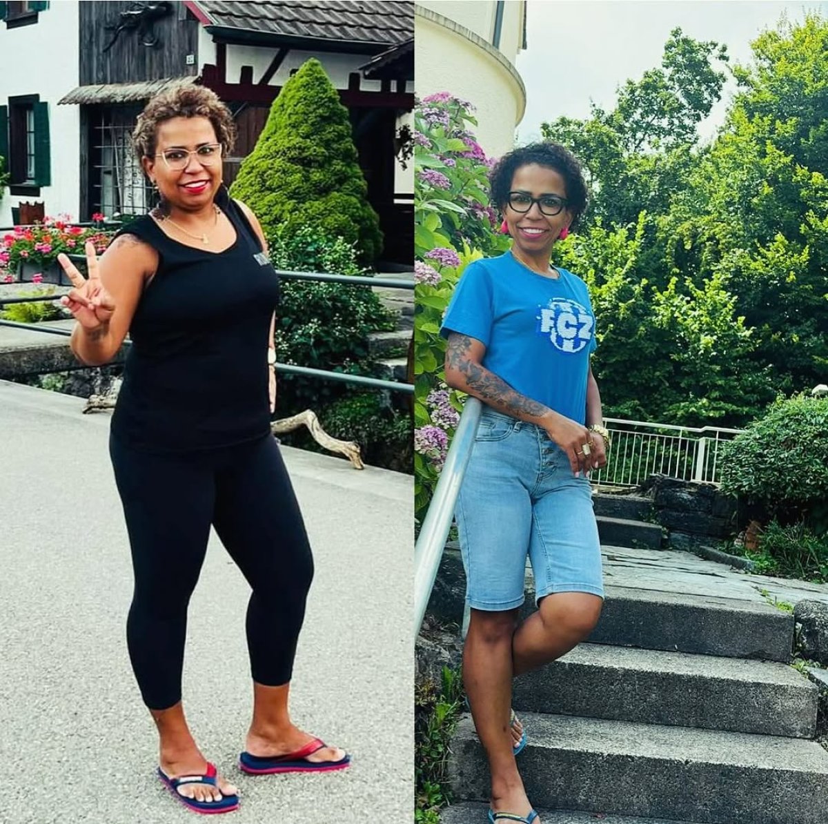 Antes y después de cirugía metabólica en Bariatric Istanbul – resultados visibles de pérdida de peso