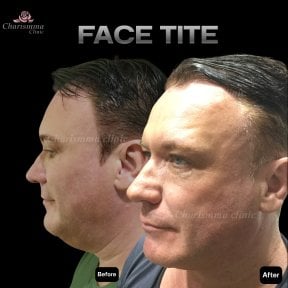 نتائج FaceTite قبل وبعد في Charismma Clinic – تحسين واضح لتحديد الوجه