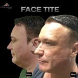 نتائج FaceTite قبل وبعد في Charismma Clinic – تحسين واضح لتحديد الوجه