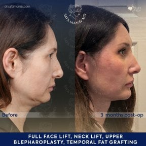 Vorher-nachher-Ergebnis Deep Plane Facelift bei Dr. Safa Manav Clinic, sichtbare Verjüngung
