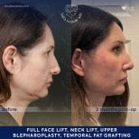 Vorher-nachher-Ergebnis Deep Plane Facelift bei Dr. Safa Manav Clinic, sichtbare Verjüngung