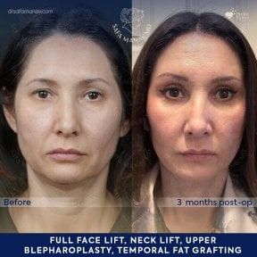 Vorher-nachher-Ergebnis Deep Plane Facelift bei Dr. Safa Manav Clinic, sichtbare Verjüngung