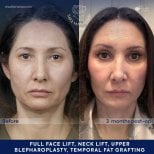 Vorher-nachher-Ergebnis Deep Plane Facelift bei Dr. Safa Manav Clinic, sichtbare Verjüngung