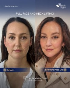 Vorher-nachher-Ergebnis Deep Plane Facelift und Halslifting bei Dr. Safa Manav Clinic