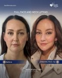 Vorher-nachher-Ergebnis Deep Plane Facelift und Halslifting bei Dr. Safa Manav Clinic