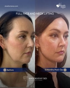 Vorher-nachher-Ergebnis Deep Plane Facelift und Halslifting bei Dr. Safa Manav Clinic