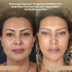Vorher-nachher-Ergebnis Deep Plane Facelift und Halslifting in der Dr. Safa Manav Klinik