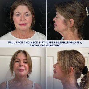 Vorher-nachher-Ergebnis Facelift, Lidstraffung, Fetttransfer bei Dr. Safa Manav Clinic