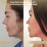 Vorher-nachher-Ergebnis Deep Plane Facelift und Halslifting in der Dr. Safa Manav Klinik