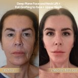 Vorher-nachher-Ergebnis Deep Plane Facelift und Halslifting in der Dr. Safa Manav Klinik