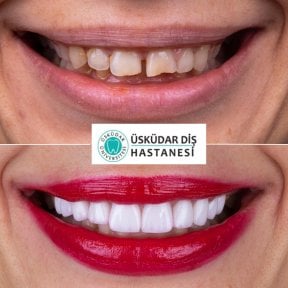 Vorher-nachher-Ergebnisse Hollywood Smile bei USKUDAR UNIVERSITY DENTAL HOSPITAL, Smile-Makeover