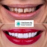 Vorher-nachher-Ergebnisse Hollywood Smile bei USKUDAR UNIVERSITY DENTAL HOSPITAL, Smile-Makeover