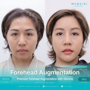 before-after photo forehead-augmentation-implant