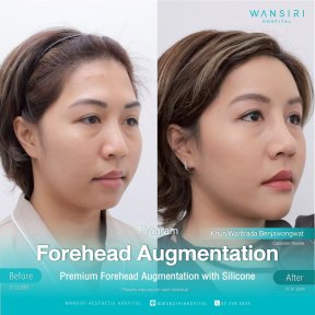 before-after photo forehead-augmentation-implant
