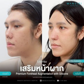 before-after photo forehead-augmentation-implant
