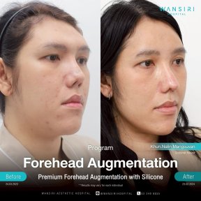before-after photo forehead-augmentation-implant