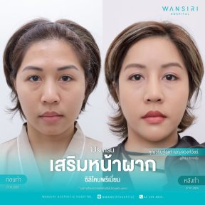 before-after photo forehead-augmentation-implant