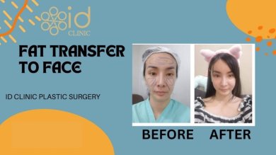 before-after photo tightening-of-facial-skin-facelift