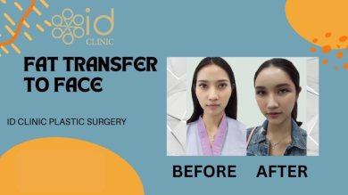 before-after photo tightening-of-facial-skin-facelift
