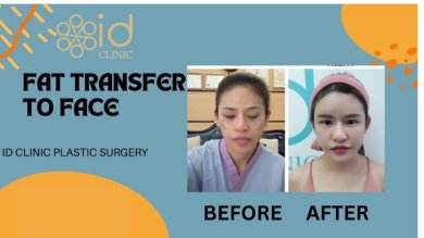 before-after photo tightening-of-facial-skin-facelift