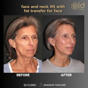 before-after photo tightening-of-facial-skin-facelift