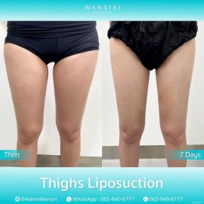 before-after photo body-lift